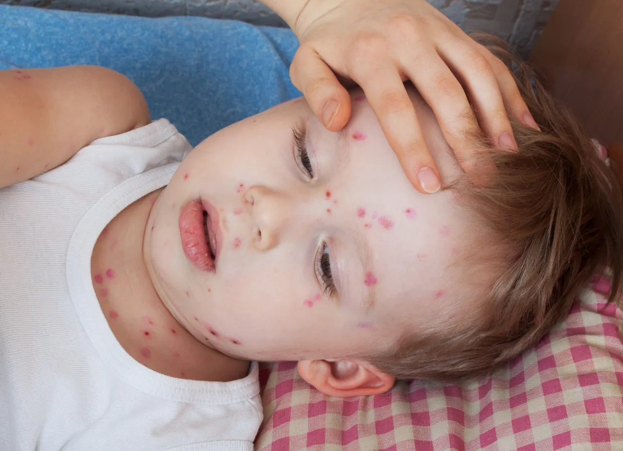 Suçiçeği vakalarında artış yaşanıyor: Korunmak çok önemli