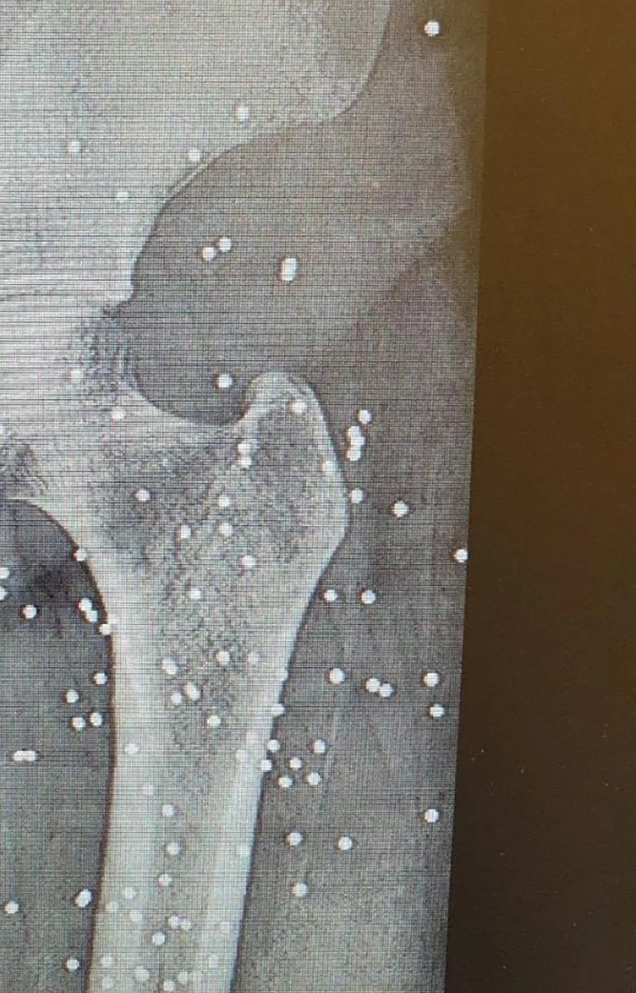 Tahran'da göstericilere ateş açılmasının ardından kalan saçmaları gösteren röntgen görüntüsü. Fotoğraf: Vahid Online