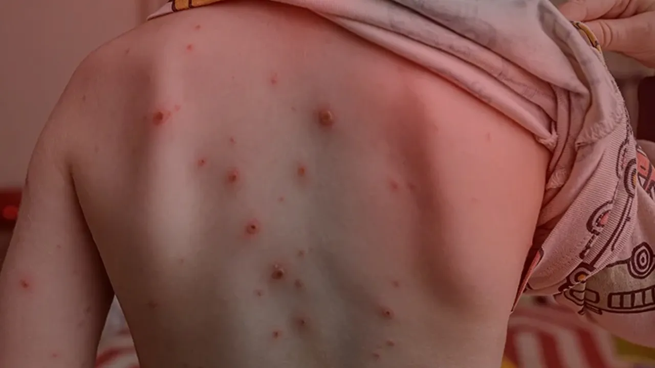 Belirtiler hızla yayılıyor… Anne babalar dikkat: Suçiçeği okullara geri döndü