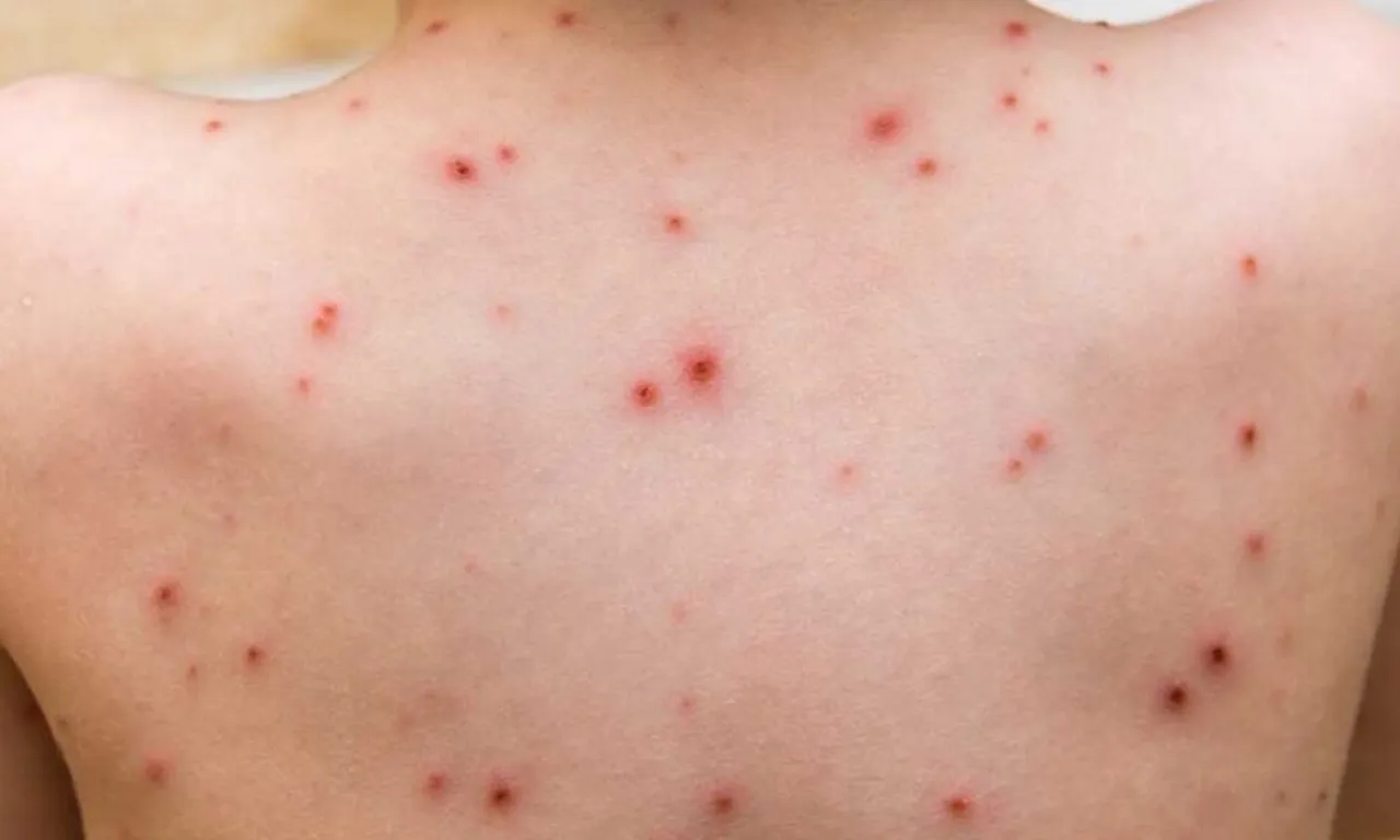 Belirtiler hızla yayılıyor… Anne babalar dikkat: Suçiçeği okullara geri döndü