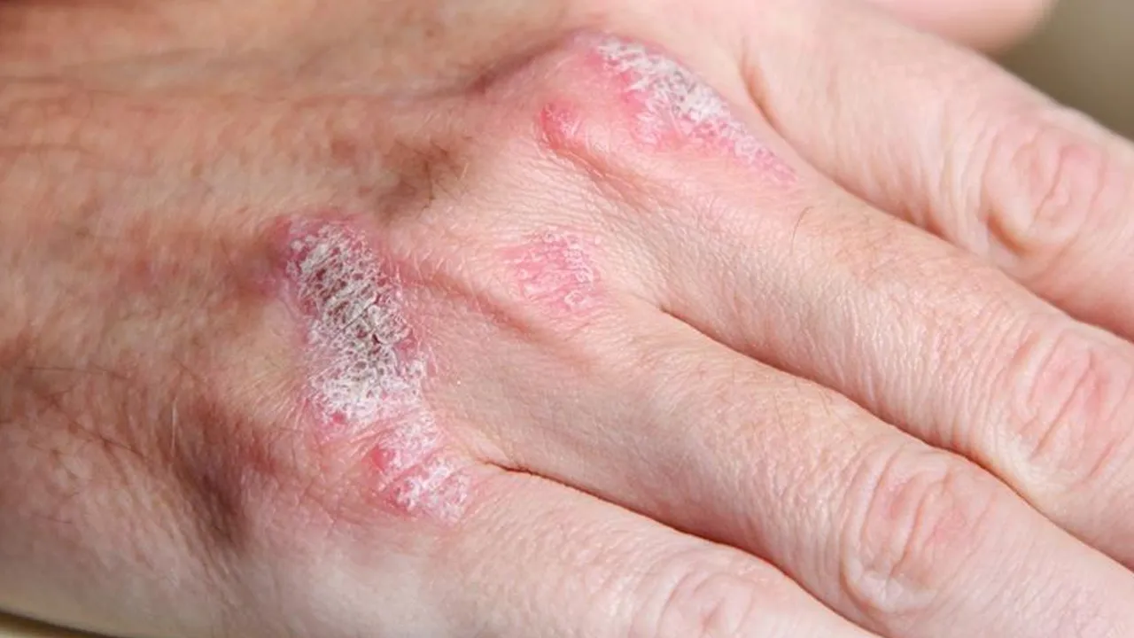 Bir sıcak bir soğuk cildi bozuyor! Soğuk hava egzama yapıyor