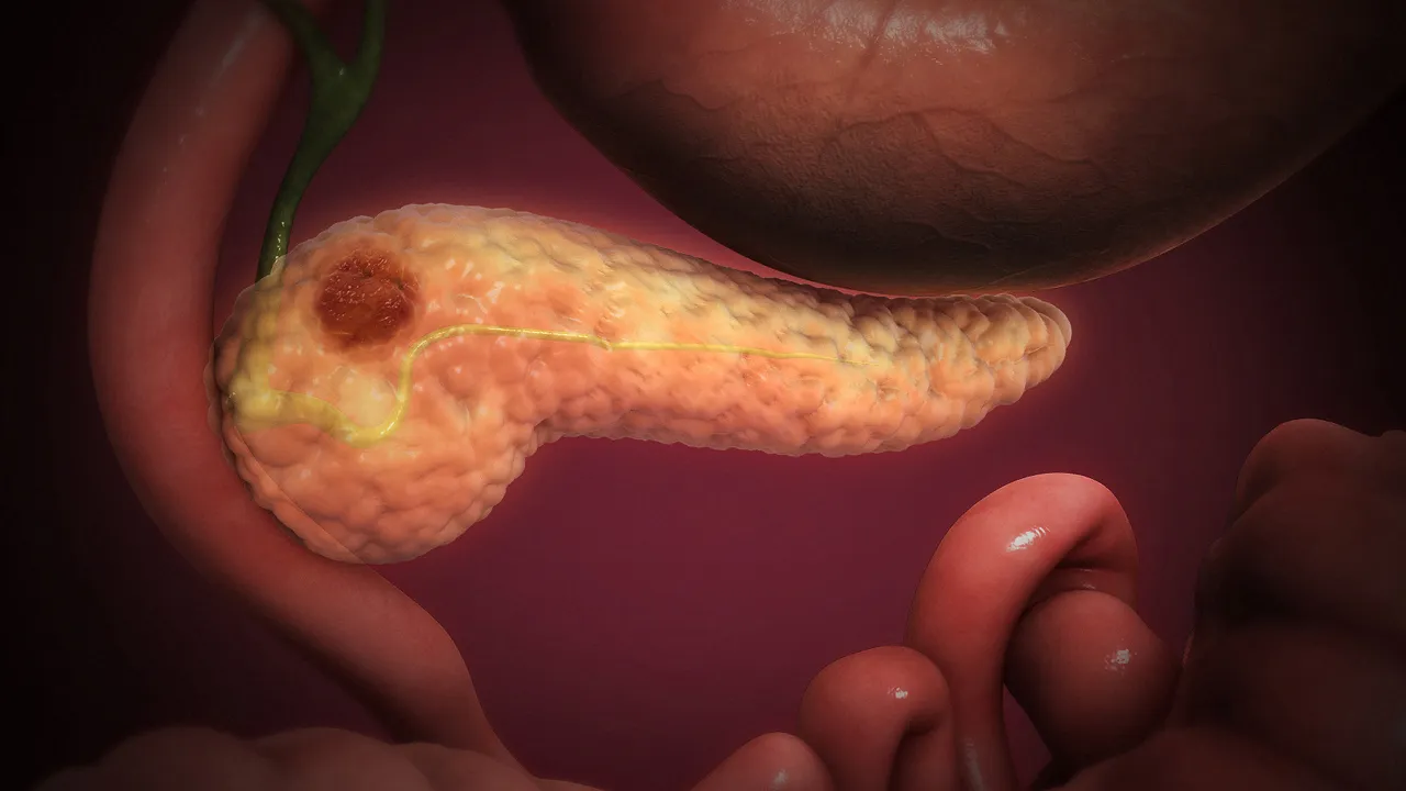 Pankreas kanserine yeni umut: Farelerde tümörler yok edildi