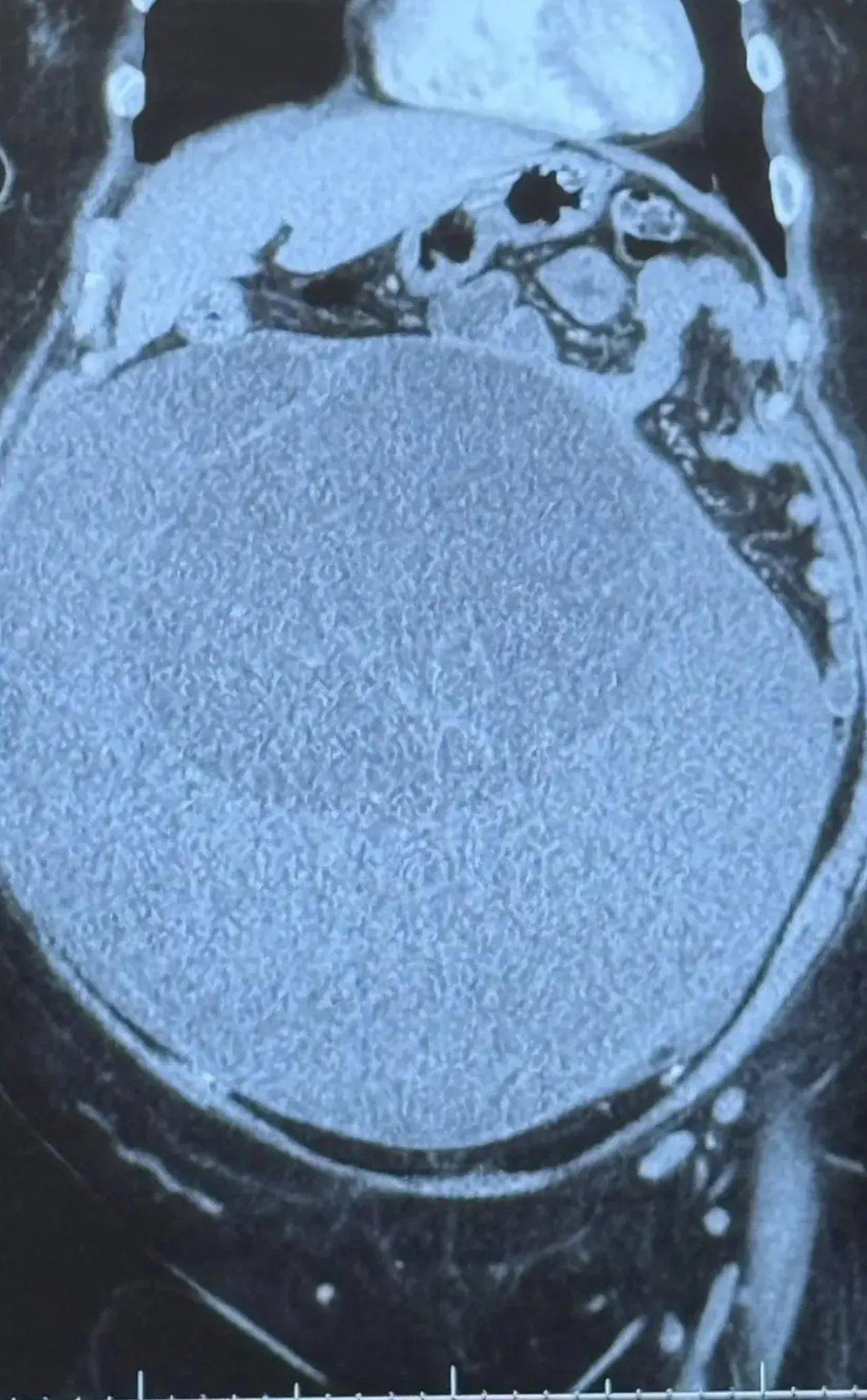 Doktorlar üç yıl boyunca “Kilo ver” dedi, görenler hamile sandı! Gerçek çok başka çıktı