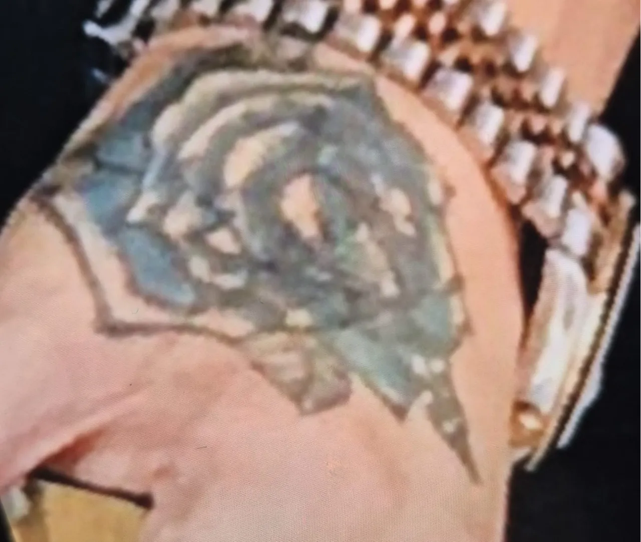 Güzellik merkezi faciası! Dövmesini sildirmek istedi, şimdi doku nakli gündemde