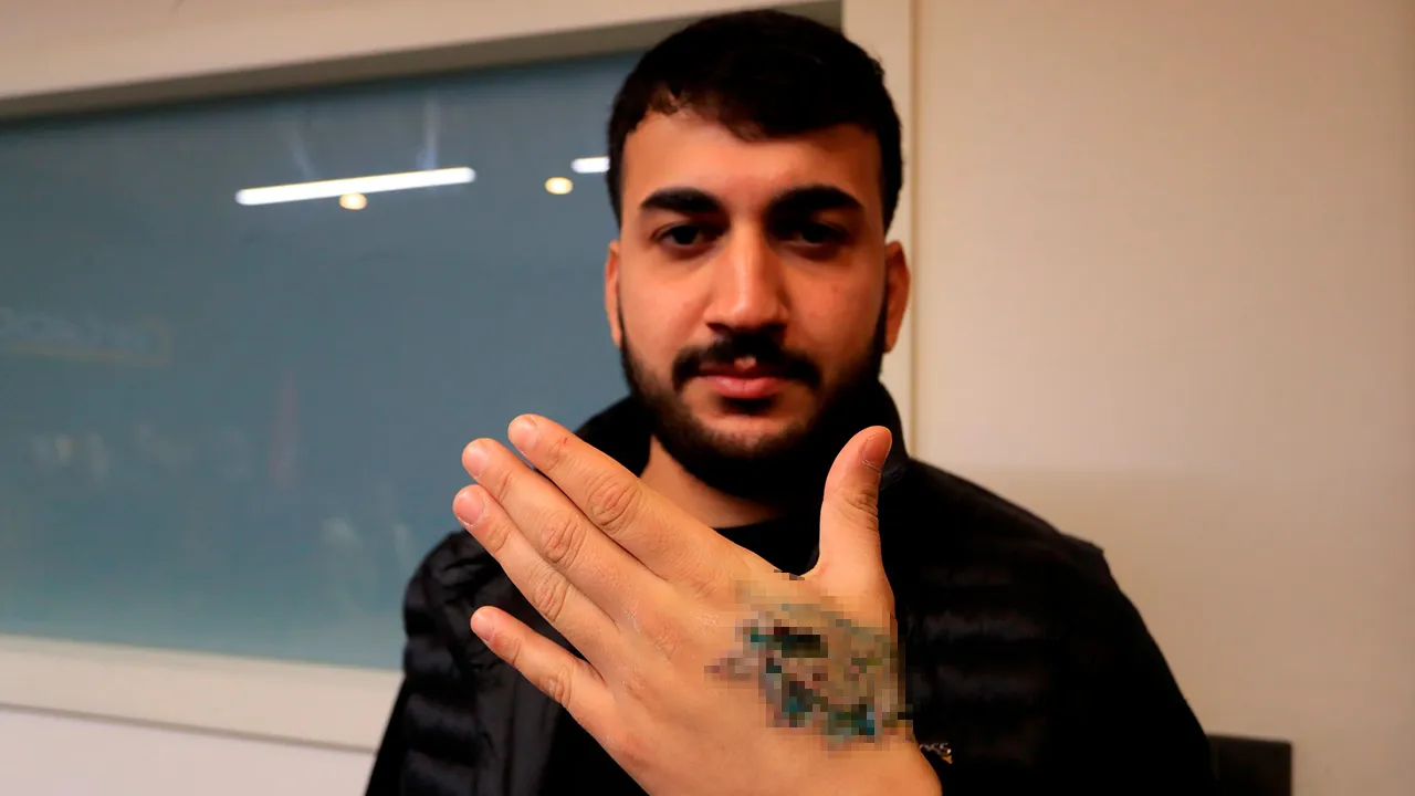 Güzellik merkezi faciası! Dövmesini sildirmek istedi, şimdi doku nakli gündemde