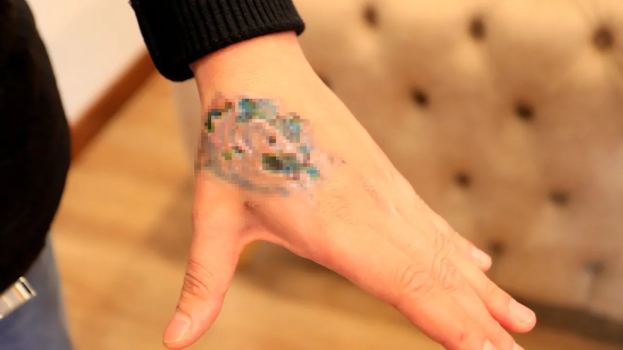 Güzellik merkezi faciası! Dövmesini sildirmek istedi, şimdi doku nakli gündemde