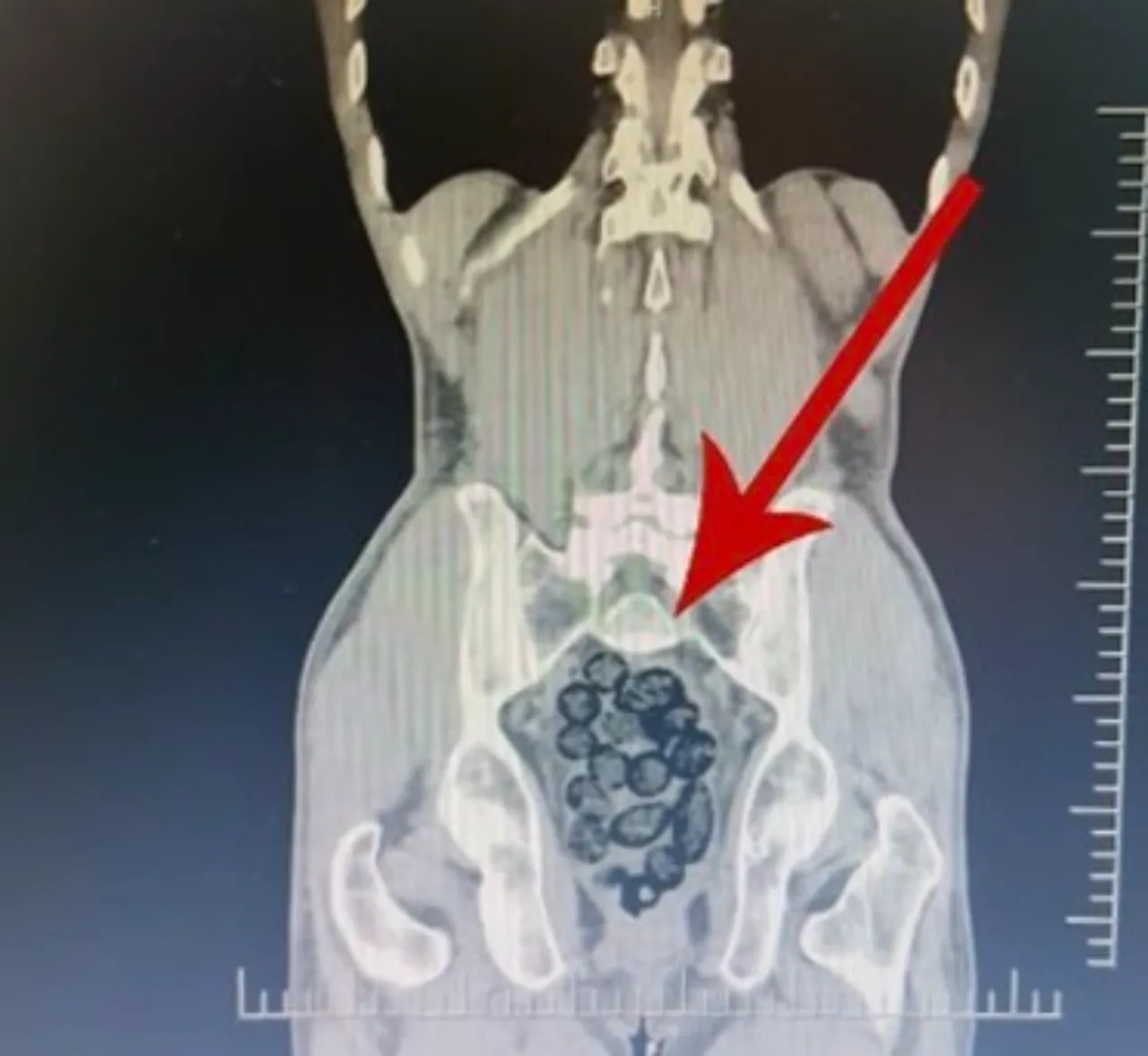 Midesini zehir deposuna çevirmiş! Batman'da yakalanan yolcunun içinden 64 paket uyuşturucu çıktı