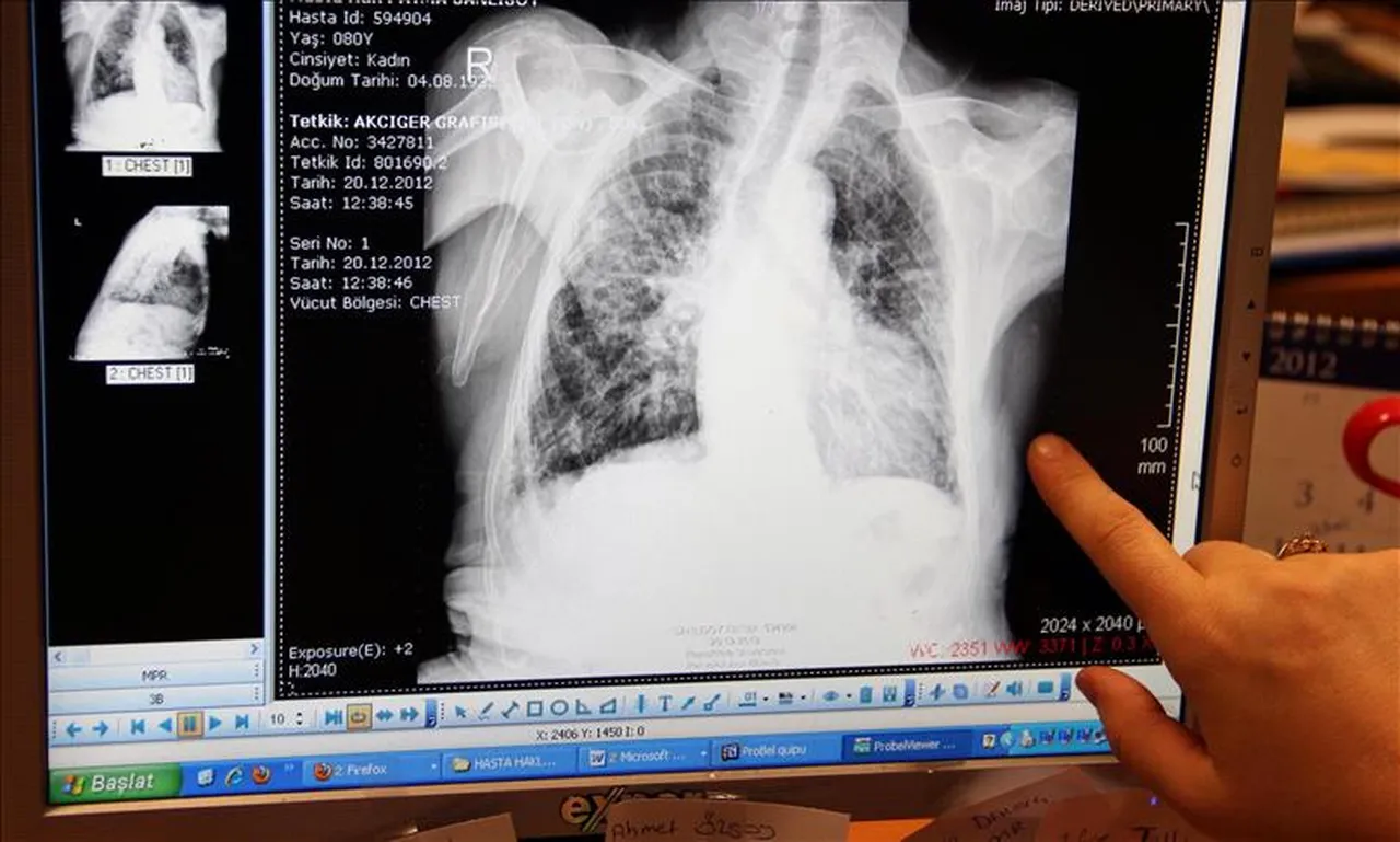 İki haftayı geçen öksürükte ‘ölümcül’ risk! Her yıl 10 milyon vaka