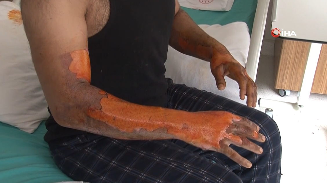 Kasisten geçti, hayatı kâbusa döndü! Vücudunun yüzde 25'i yandı: Bomba gibi patladı, kendimi zor kurtardım
