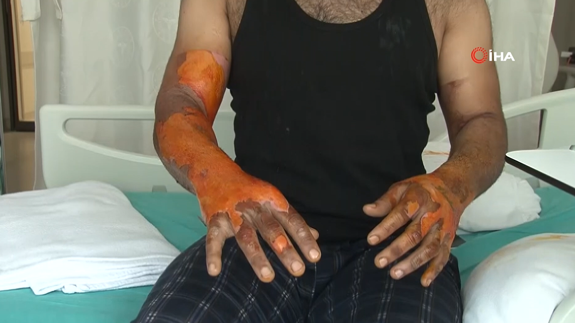 Kasisten geçti, hayatı kâbusa döndü! Vücudunun yüzde 25'i yandı: Bomba gibi patladı, kendimi zor kurtardım