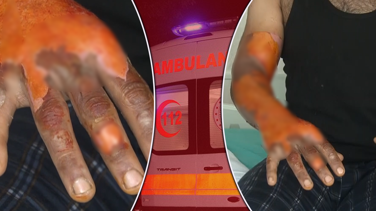 Aküsü patladı, vücudunun yüzde 25'i yandı