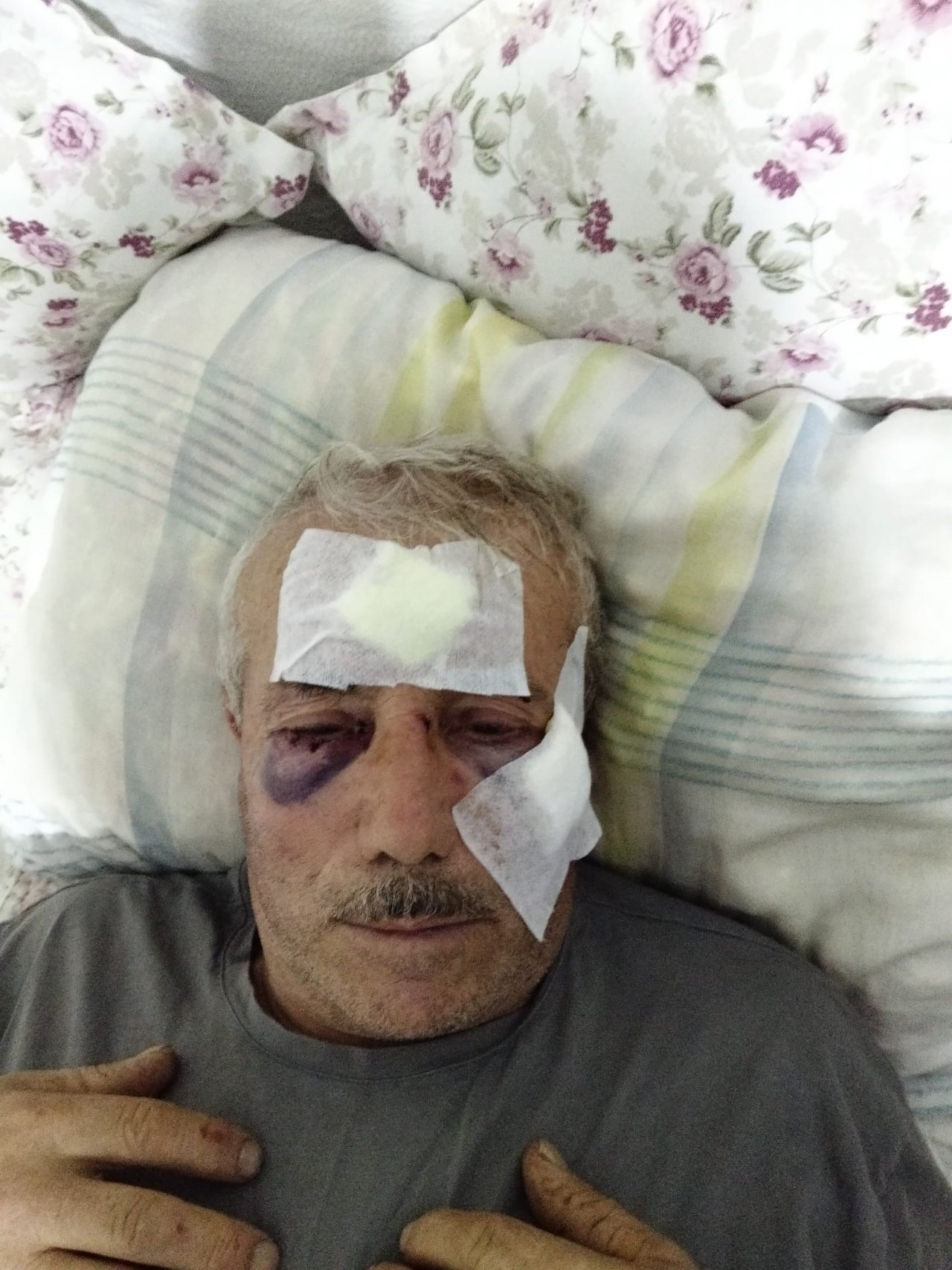 Kemikleri kırıldı, işitme kaybı yaşadı, yüzünde 9 dikiş var! Öğretmenden 68 yaşındaki komşusuna muştalı saldırı