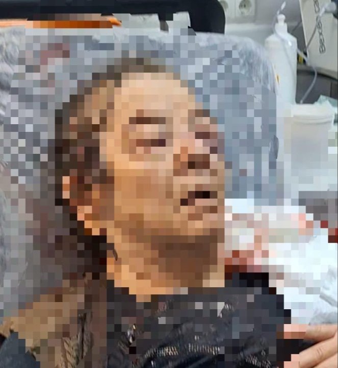 Evinde televizyon izlerken dehşeti yaşadı! Tavan çöktü, bir gözünü kaybetti