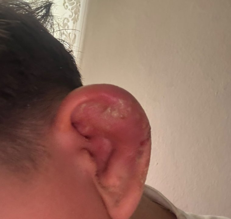 Piercing yaptırdı, hayatı kabusa döndü! Aile savcılığa koştu