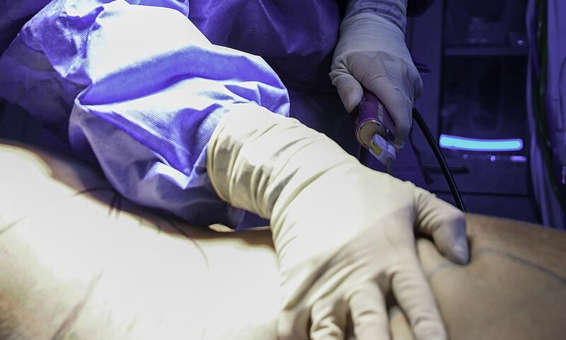 Liposuction, Türkçede yağ aldırma ameliyatı olarak bilinen, vücudun belirli bölgelerinde biriken fazla yağların cerrahi yöntemle alınmasını sağlayan estetik bir işlemdir.