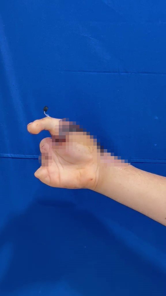 Ayak parmağı eline nakledildi! 5 parmağı kopan 13 yaşındaki çocuğa nadir ameliyat: 4 ay sonra kullanabilecek