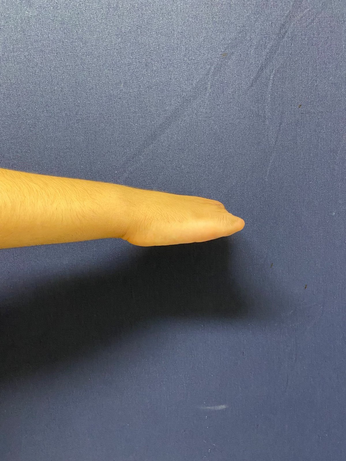 Ayak parmağı eline nakledildi! 5 parmağı kopan 13 yaşındaki çocuğa nadir ameliyat: 4 ay sonra kullanabilecek