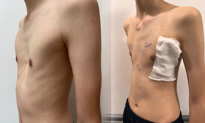 Göğsündeki çöküklük ileri düzeydeydi… Ameliyat oldu, vücudunda 3 yıl kalacak