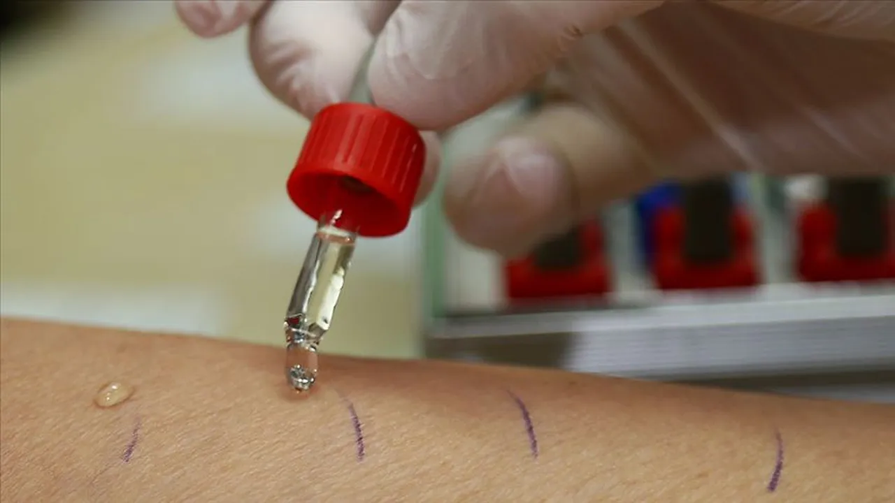 Her 20 çocuktan birinde görülüyor! İşte alerji riski olan 4 gıda