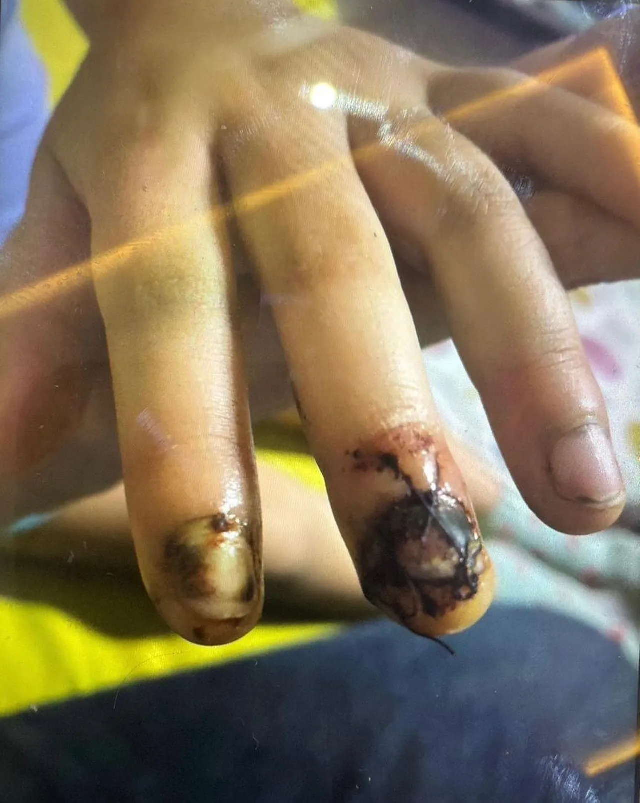 Diyarbakırda özel okulda 3 yaşındaki çocuğu hastanelik eden ihmal! Parmakları ezildi