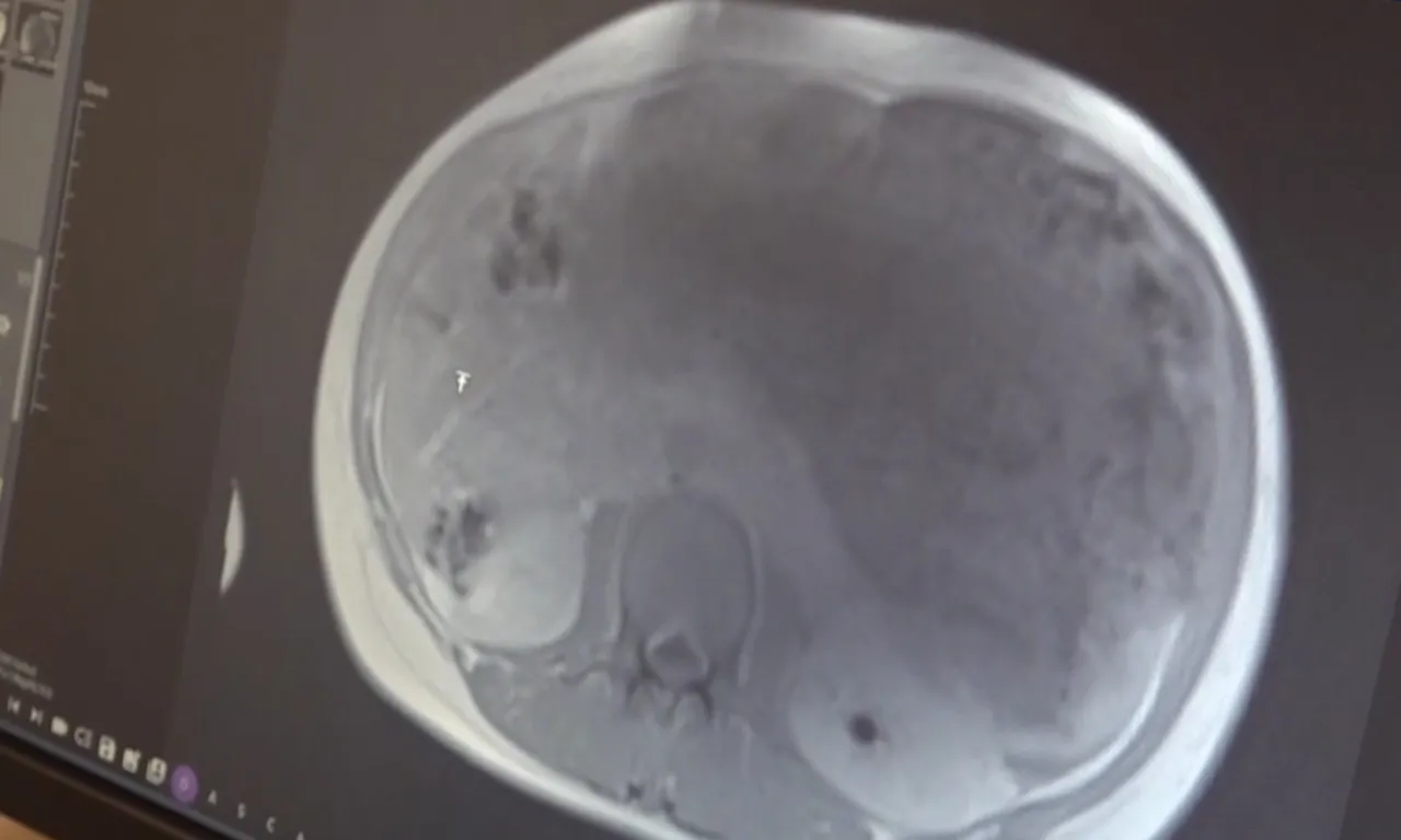 Midesinde sertlik fark etti! 6 çocuk annesi kadının karnından iki bebek büyüklüğünde kitle çıktı