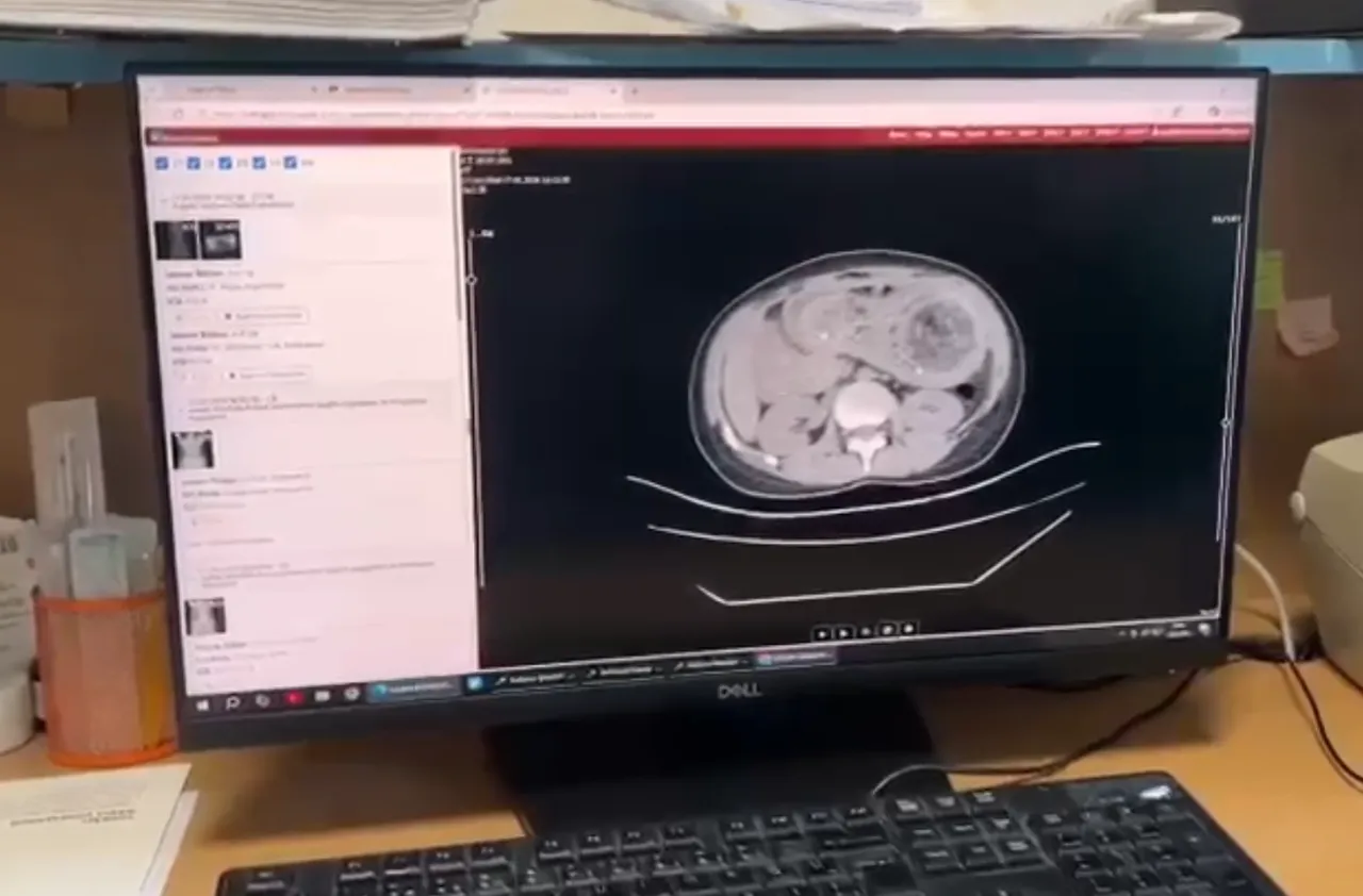 Karnından 3 kilo saç yumağı çıktı! Sebebi göz yaşartıyor