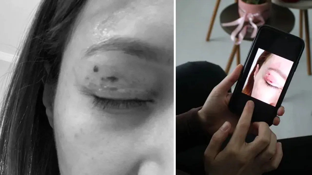 1100 liralık 'plazma pen' hayatını kararttı! Artık gözünü kapatamıyor