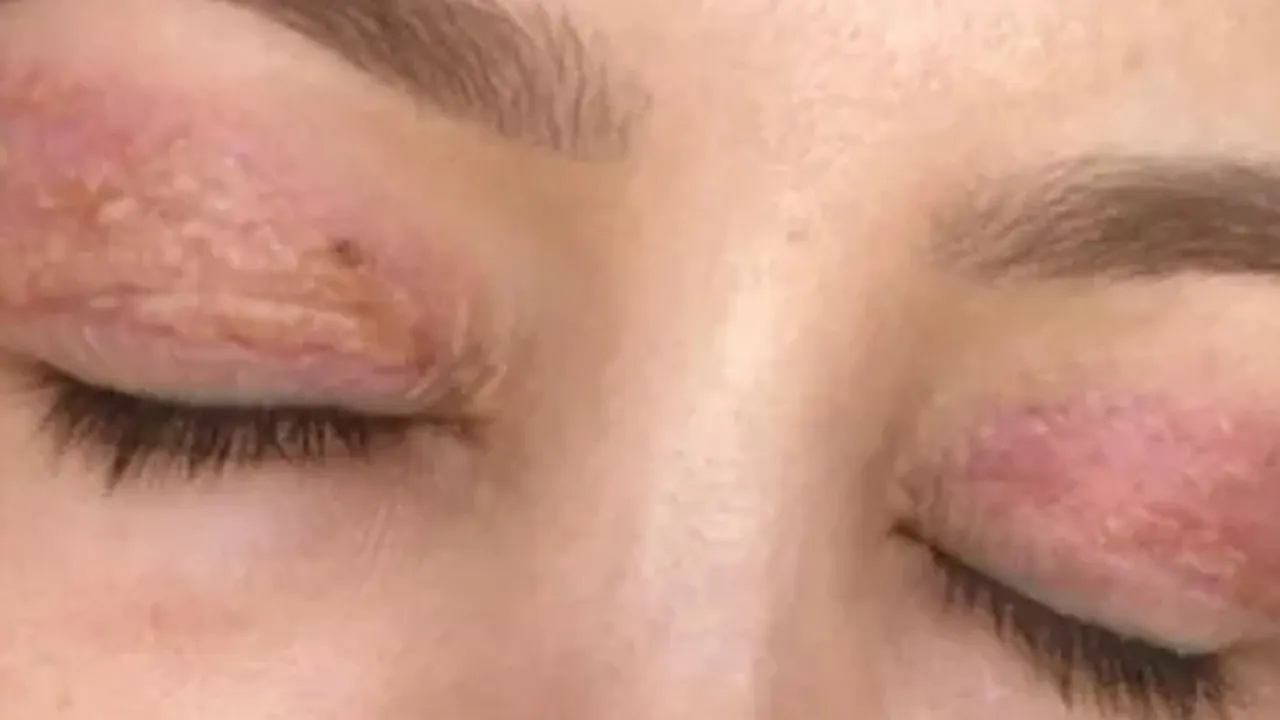 1100 liralık 'plazma pen' hayatını kararttı! Artık gözünü kapatamıyor