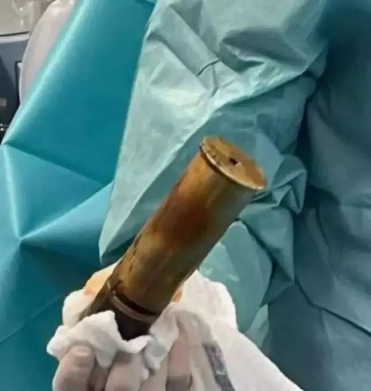 Böylesi ne görüldü ne duyuldu! Rektumundan Birinci Dünya Savaşı’ndan kalma mühimmat çıktı