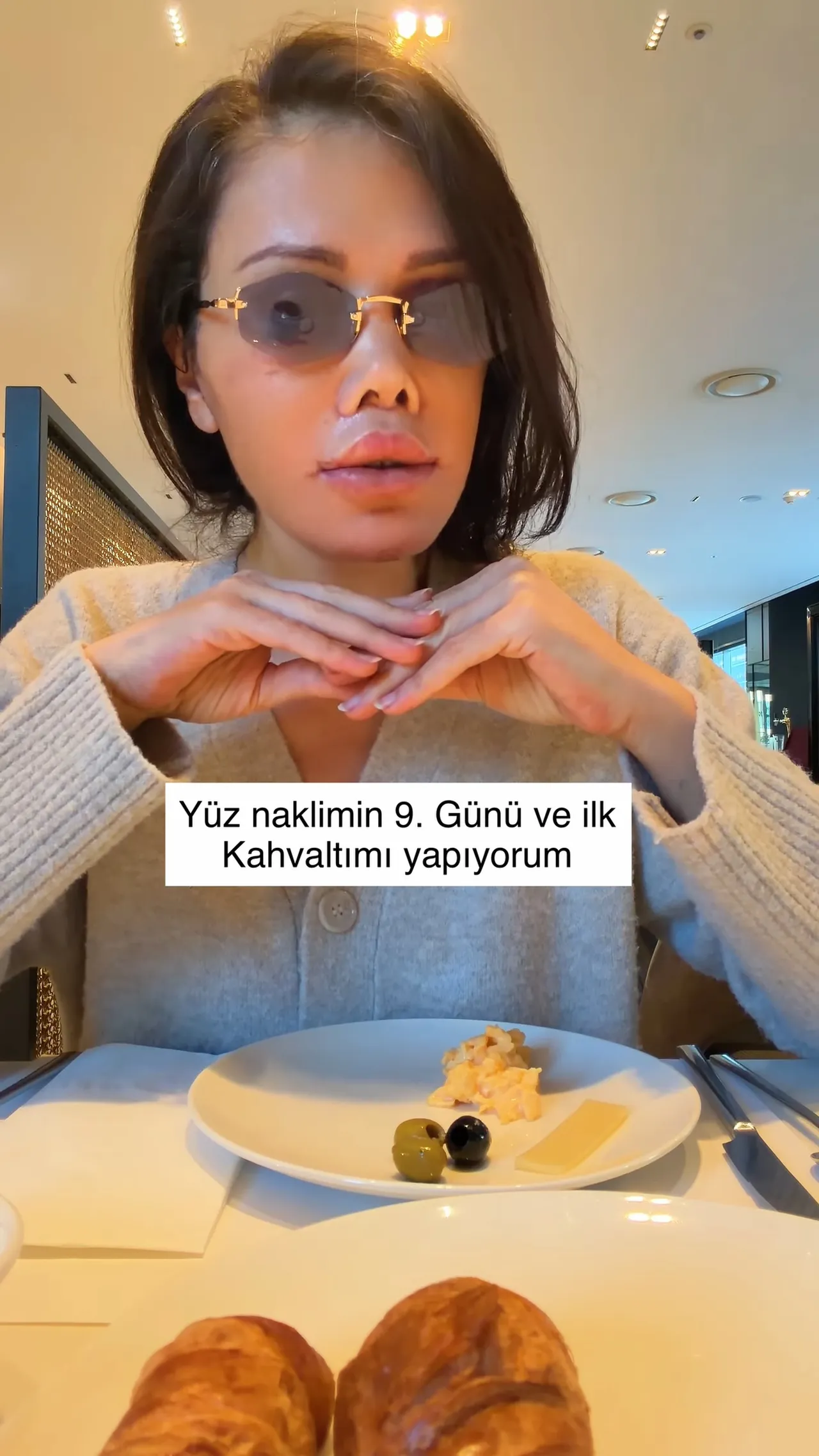 Survivor Didem Ceran yüz nakli oldu! Yeni fotoğraflarını paylaştı