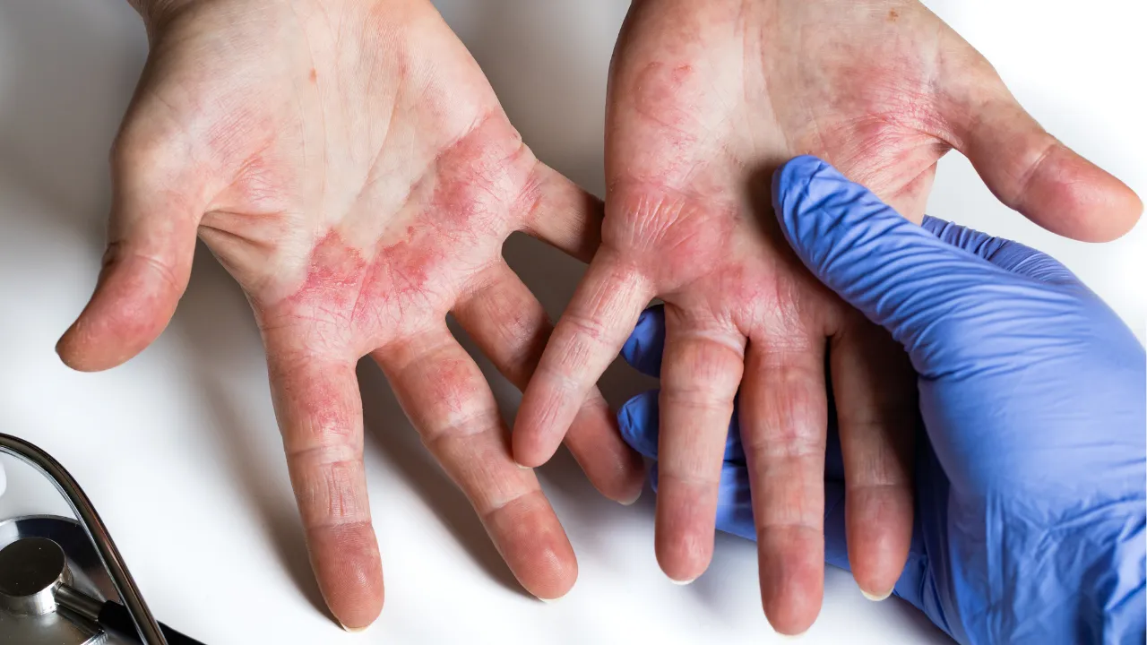 Yıllarca egzama sanmıştı! Acı gerçek lenf bezleri şişince ortaya çıktı