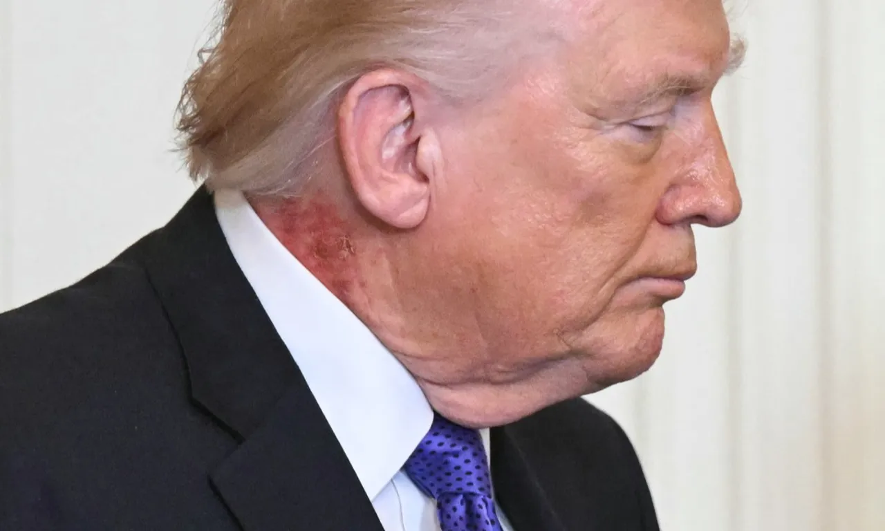 Boynunda gizemli döküntü! Trump’ın sağlığı yeniden tartışma konusu oldu