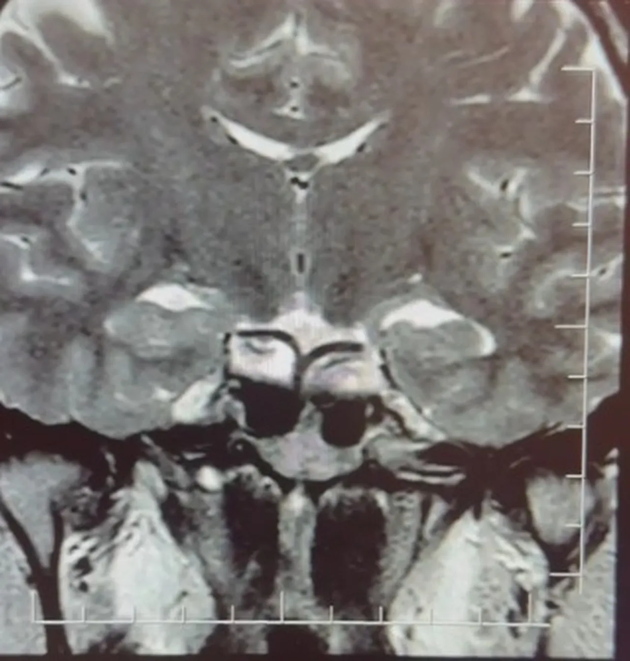 ‘Hamileyim’ diye geldi, hastalığı ortaya çıktı! Bebek beklerken şoku yaşadı