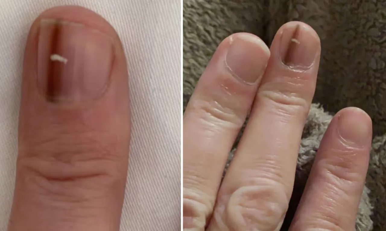 Başka hiçbir şikayeti yoktu… Tırnak altındaki çizgi ölümcül hastalığın işareti çıktı!