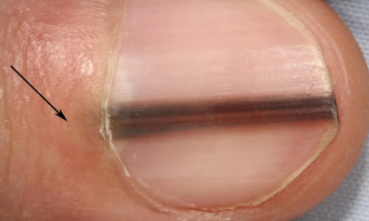 Başka hiçbir şikayeti yoktu… Tırnak altındaki çizgi ölümcül hastalığın işareti çıktı!