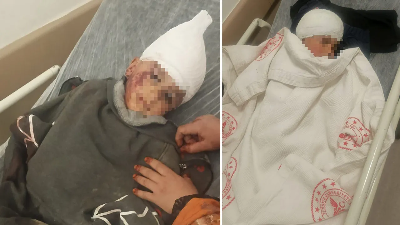 Başıboş köpek saldırmıştı! Küçük çocuk 3 ameliyat geçirdi