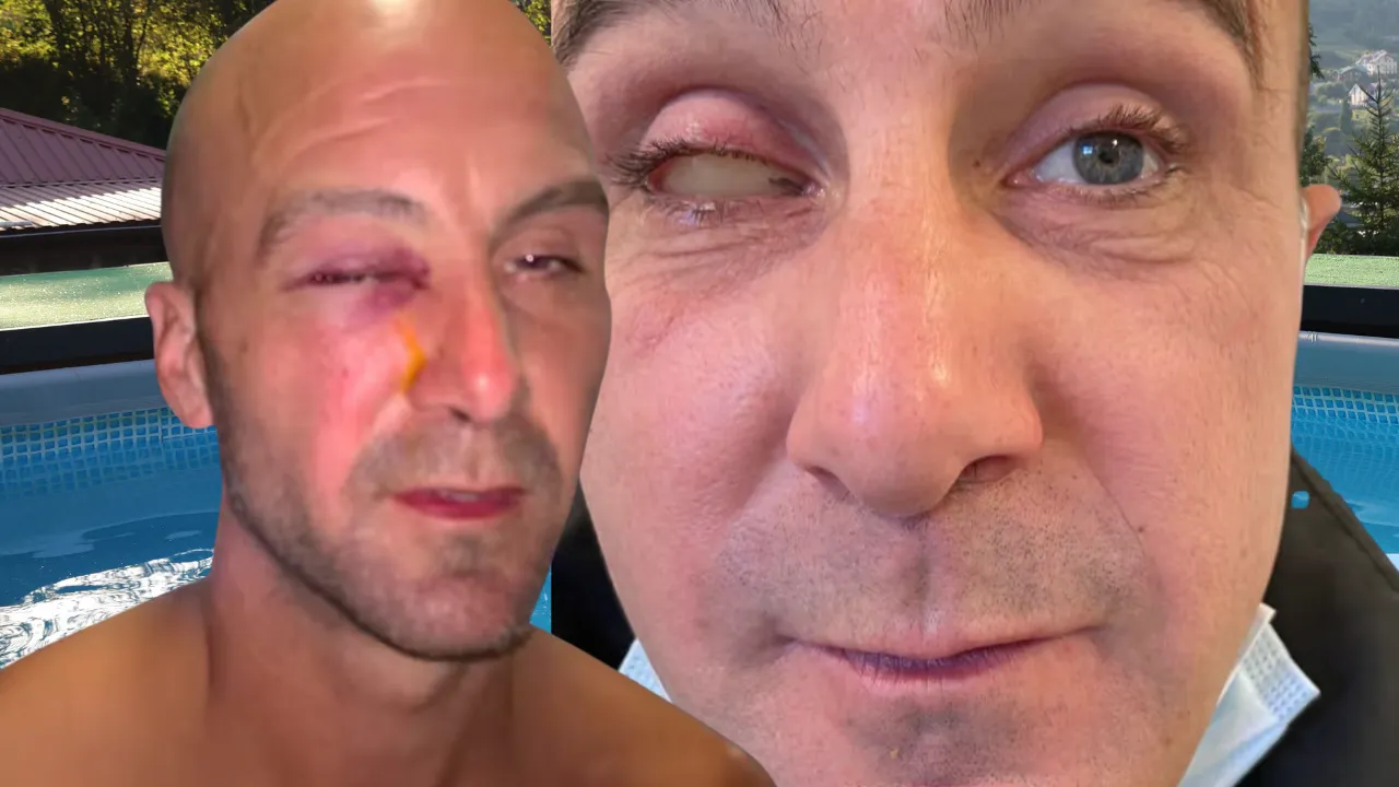 Tatil için gitmişti, gözünü kaybederek döndü! Korkunç 'tırnak' faciası