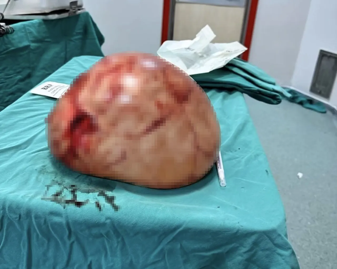 Karın ağrısı şikayetiyle gitti, karnından 35 santimetrelik kitle çıkarıldı