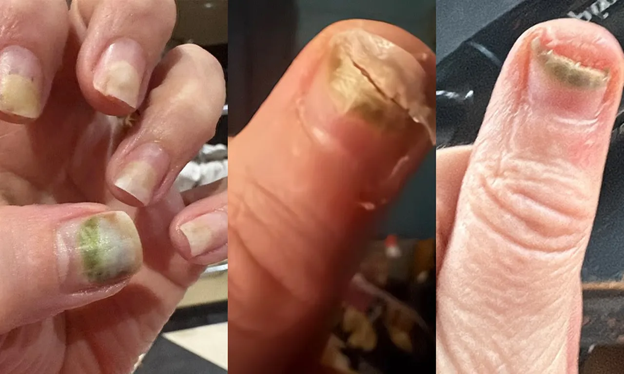 Yaptırdığı manikür sonrası tırnakları yeşile döndü, kötü koku yayıldı! Kabus tam 2 ay sürdü