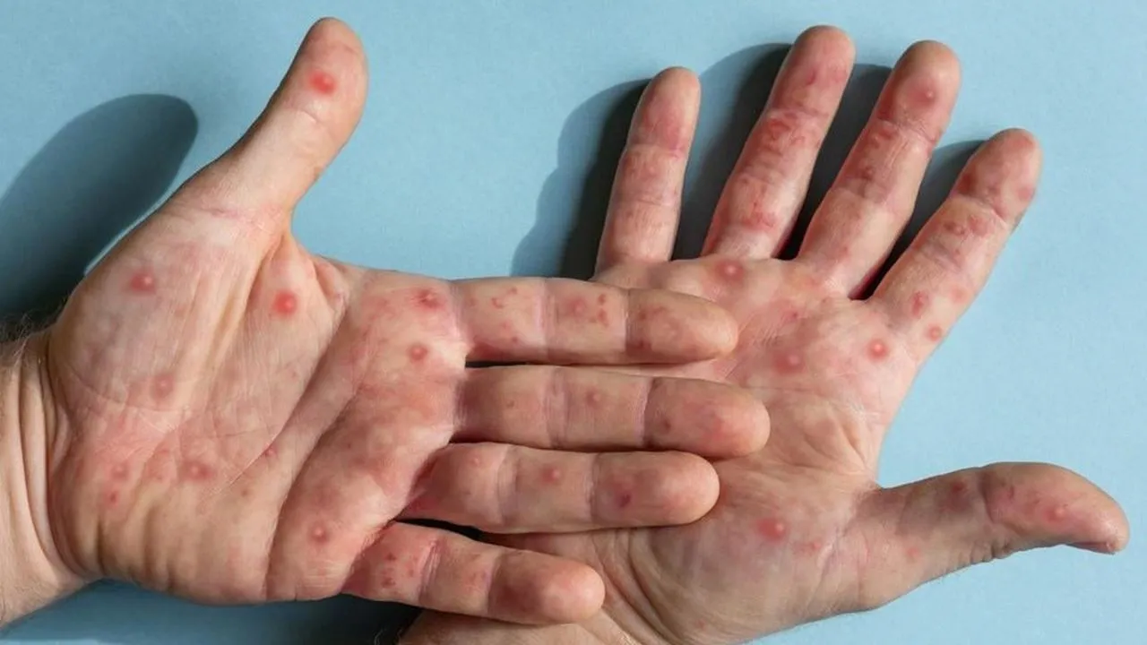 M çiçeği virüsü Türkiyede görüldü mü, belirtileri neler? Bulaşma yolları ve tedavisi!