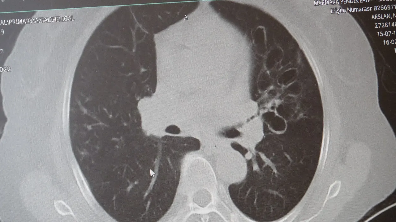 Dünyada en çok öldüren 4'üncü hastalık! 65 yaş üstü risk altında, akciğeri parçalıyor