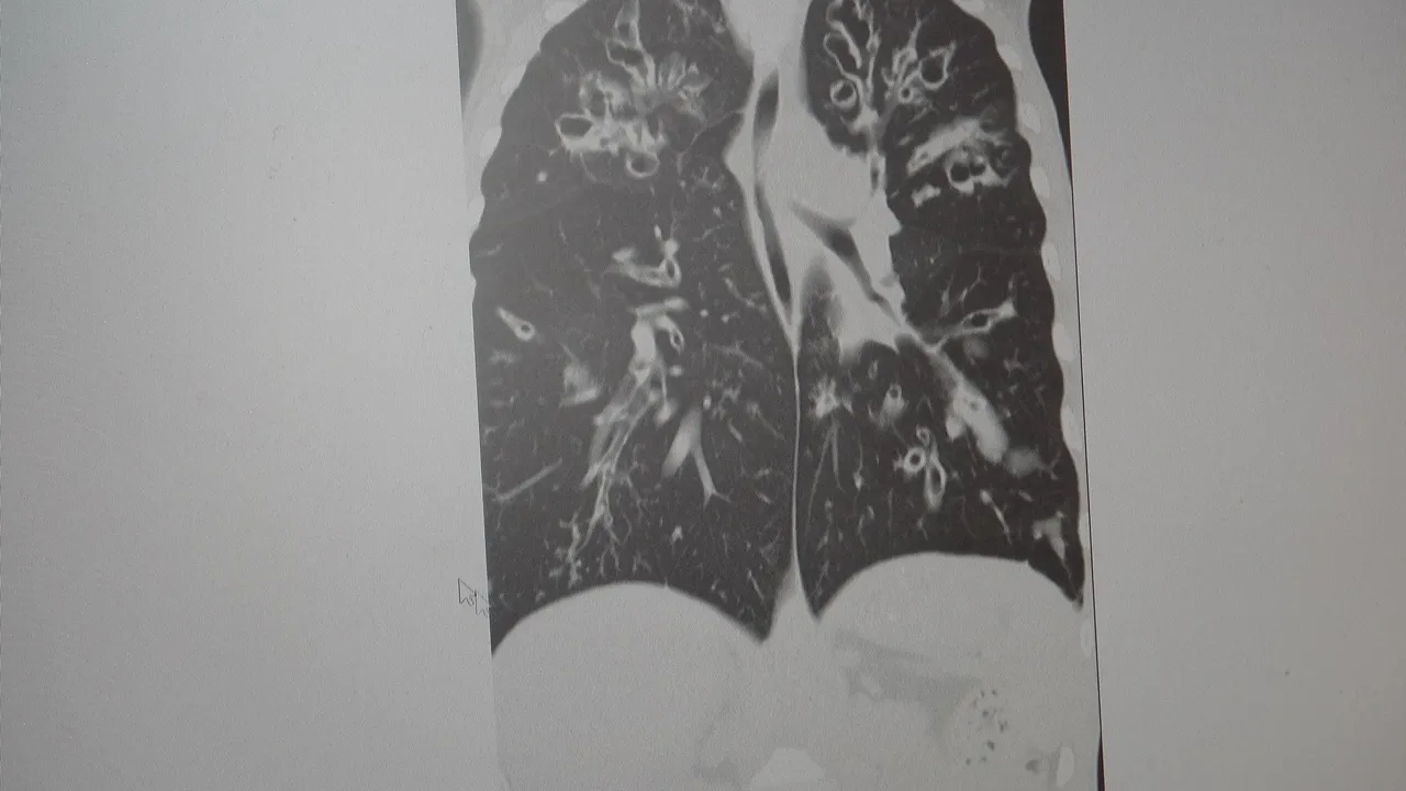 Dünyada en çok öldüren 4'üncü hastalık! 65 yaş üstü risk altında, akciğeri parçalıyor