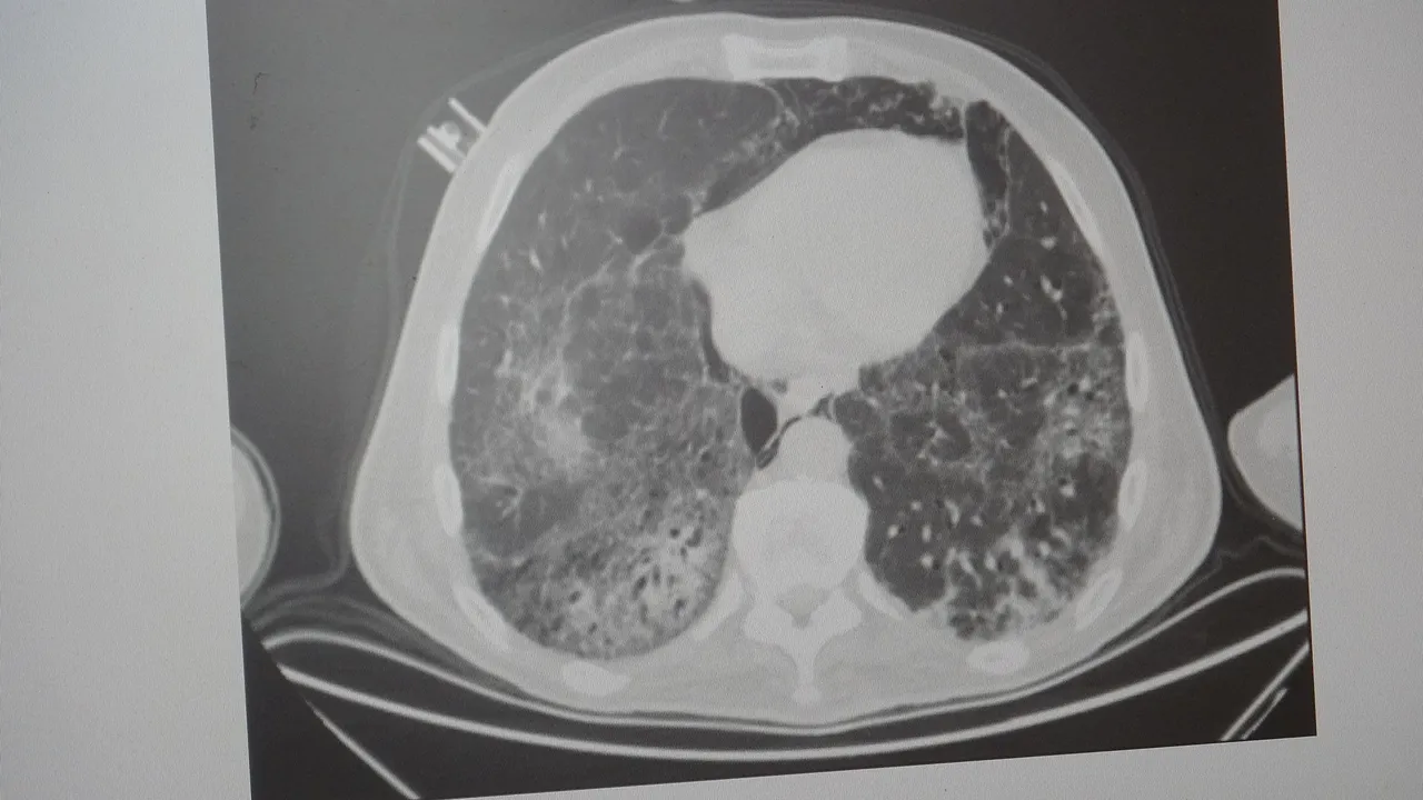 Dünyada en çok öldüren 4'üncü hastalık! 65 yaş üstü risk altında, akciğeri parçalıyor