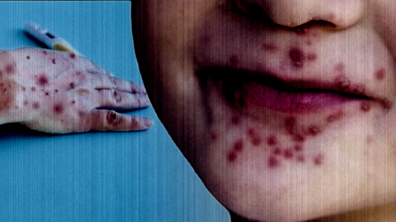 Salgın alarmı verildi! Çocuklarda el ve ağızda döküntüye dikkat: İşte ilk sinyaller