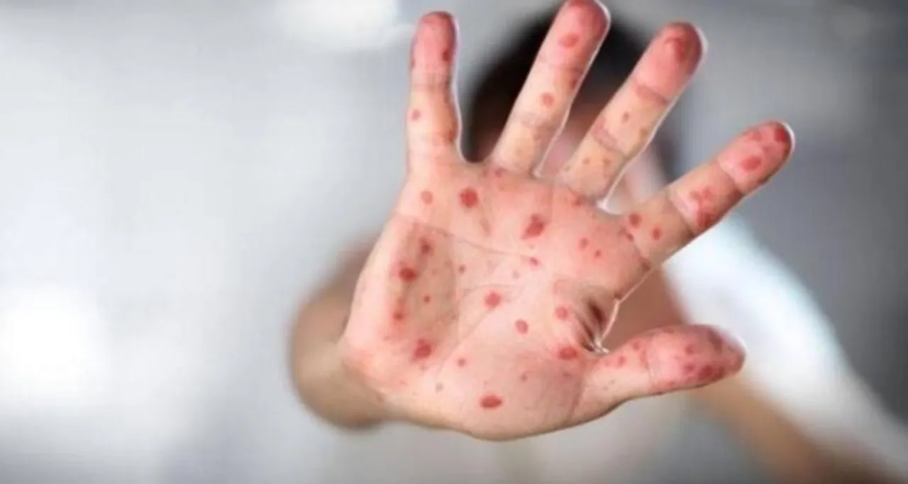 Salgın alarmı verildi! Çocuklarda el ve ağızda döküntüye dikkat: İşte ilk sinyaller