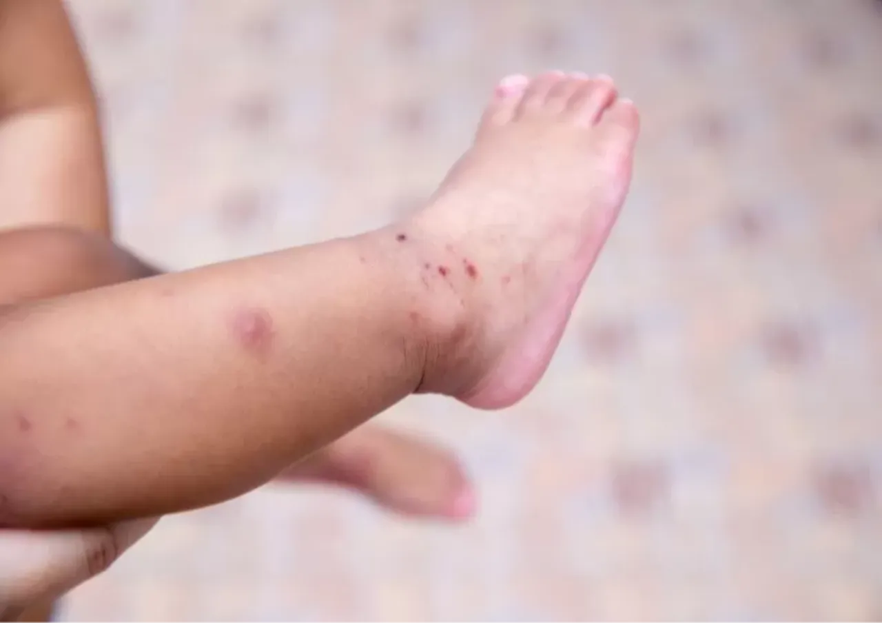 Salgın alarmı verildi! Çocuklarda el ve ağızda döküntüye dikkat: İşte ilk sinyaller