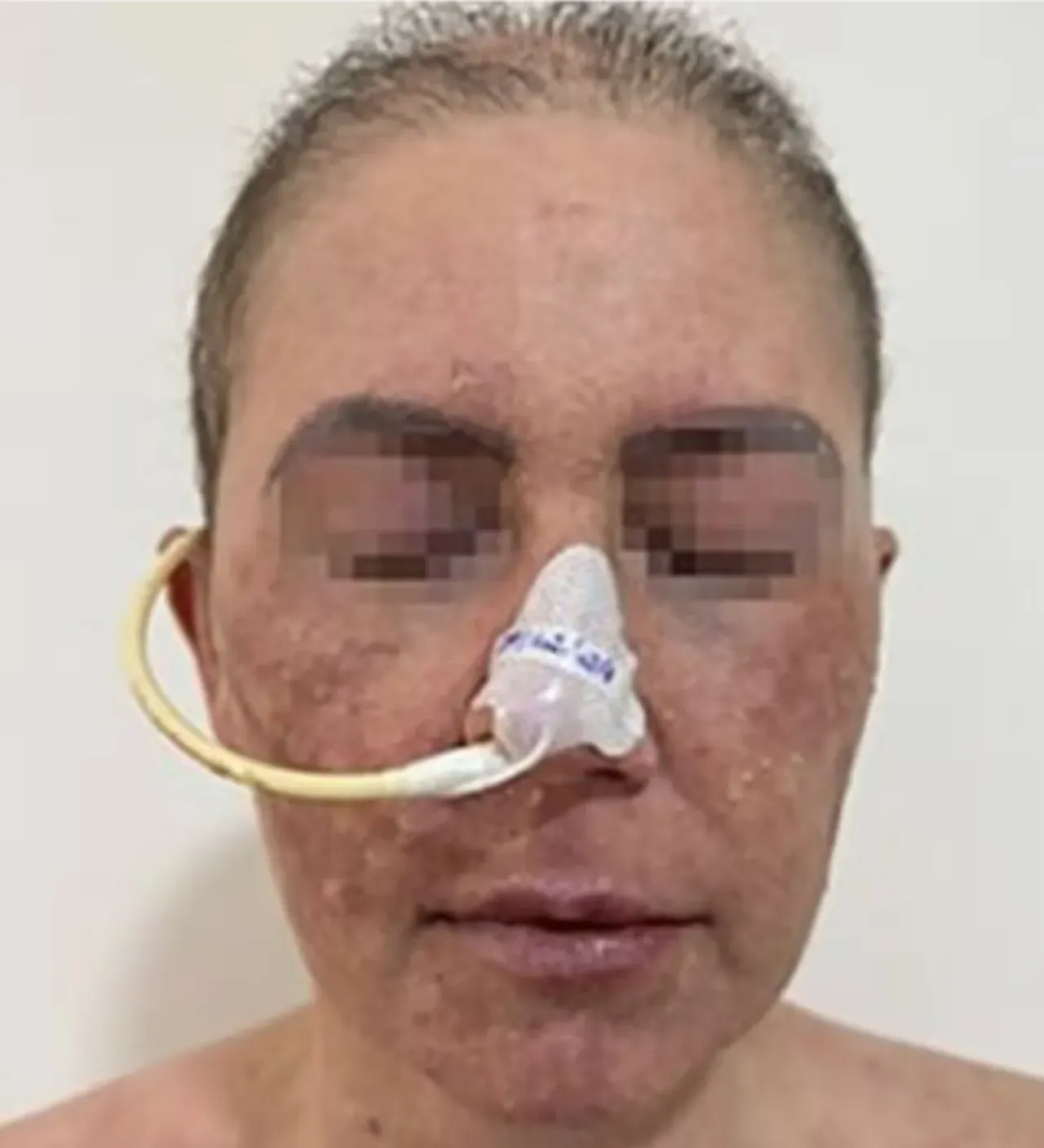 Kullandığı ilaç hayatını kararttı! Vücudu önce yandı sonra soyuldu