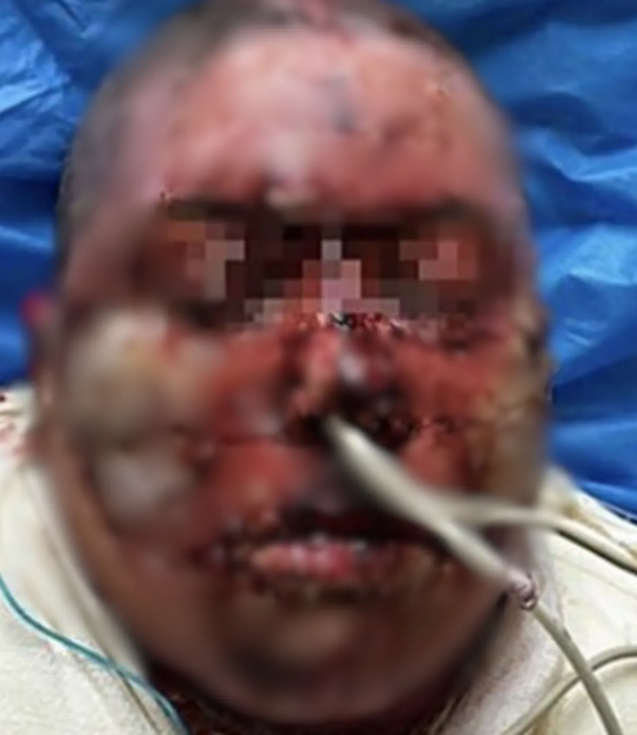 Kullandığı ilaç hayatını kararttı! Vücudu önce yandı sonra soyuldu