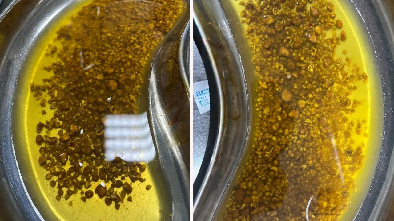 Doktorlar bile şaşırdı: Safra kesesinden 2 binden fazla taş çıktı