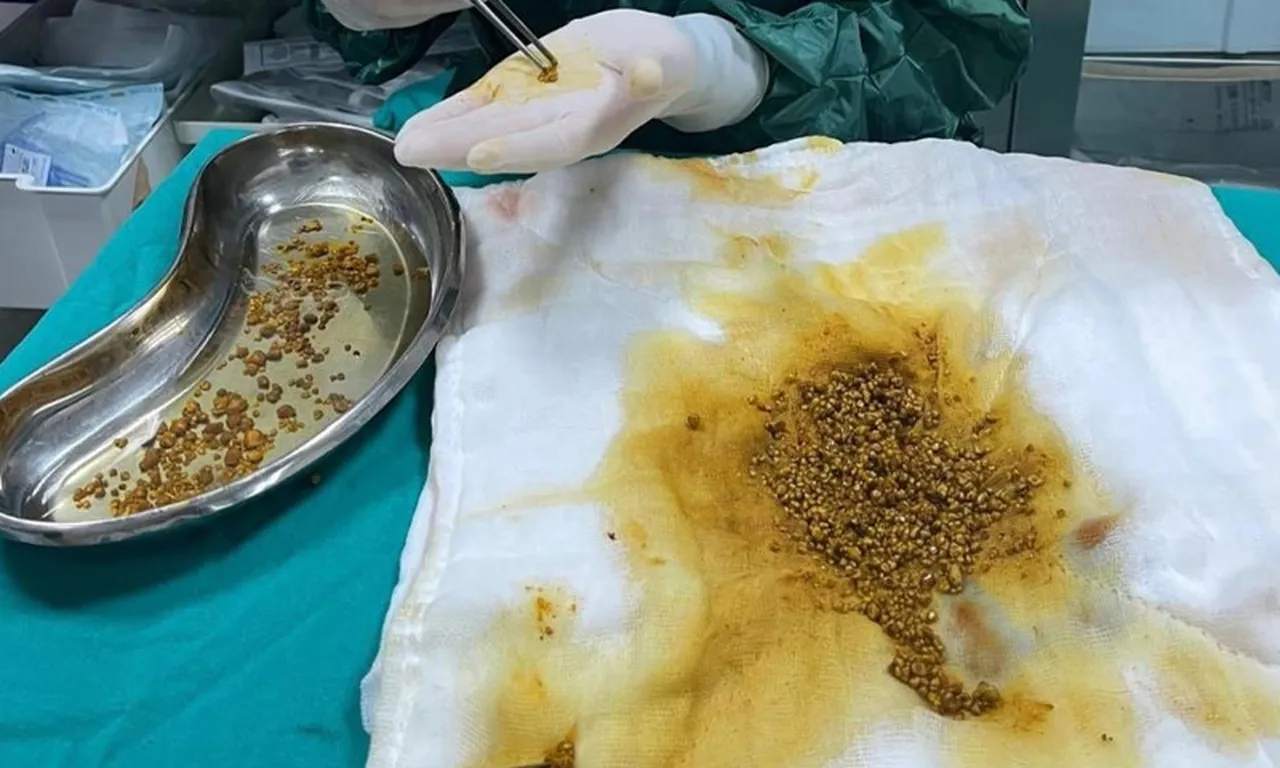 Doktorlar bile şaşırdı: Safra kesesinden 2 binden fazla taş çıktı
